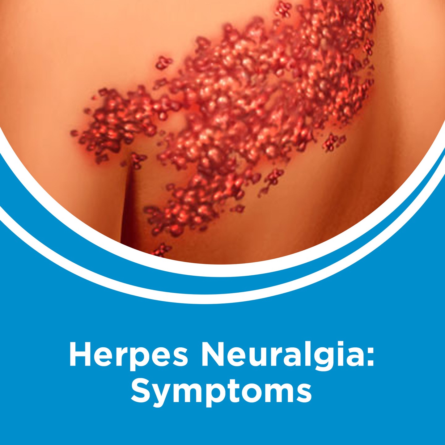 Herpes Neuralgia – Symptoms