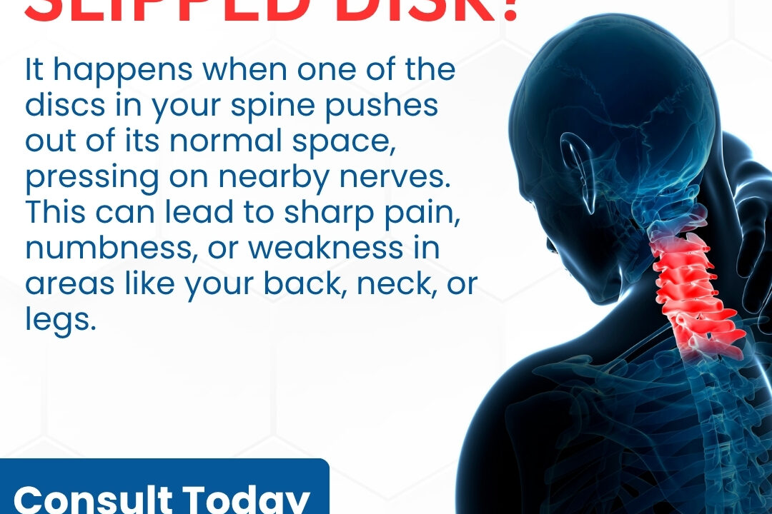Dealing with a Slipped Disc?